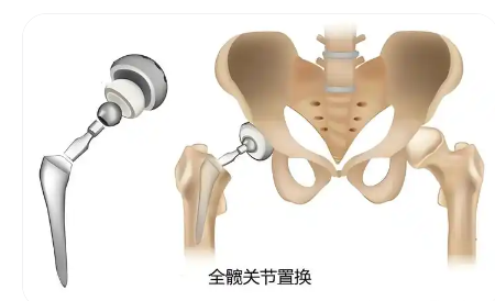 髖關(guān)節(jié)置換手術(shù)導航定位系統(tǒng)ropaplasty-01代理